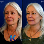 Facelift San Diego Before and After 100