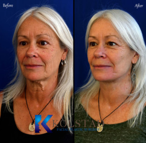Facelift San Diego Before and After 100