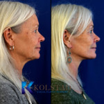 Natural Facelift Before and After Recovery Photos