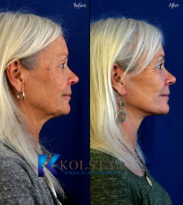 Natural Facelift Before and After Recovery Photos