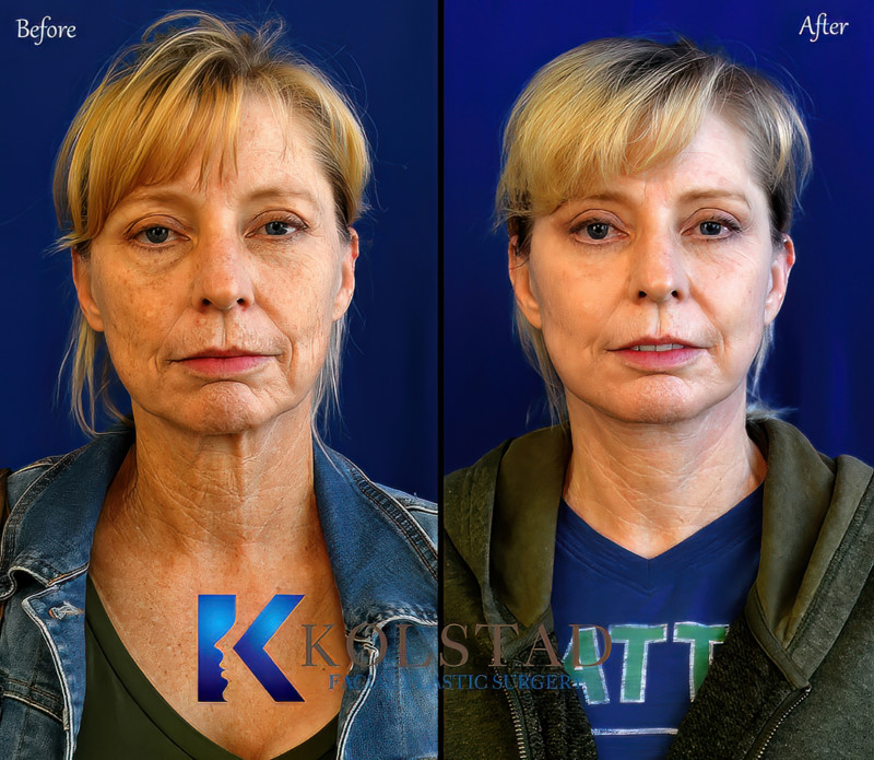 Facelift Before & After Gallery 4 Dr. Kolstad San Diego Facial
