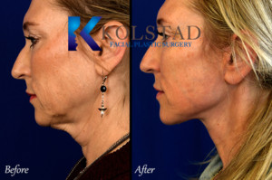 Facelift Surgeon San Diego