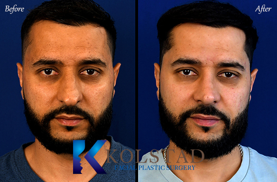rhinoplasty photos for ethnic males