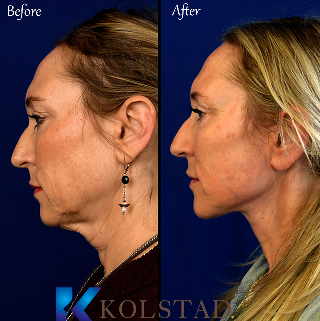 Facelift San Diego Dr. Kolstad San Diego Facial Plastic Surgeon