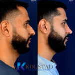 best mens rhinoplasty for ethnic noses