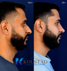 best mens rhinoplasty for ethnic noses