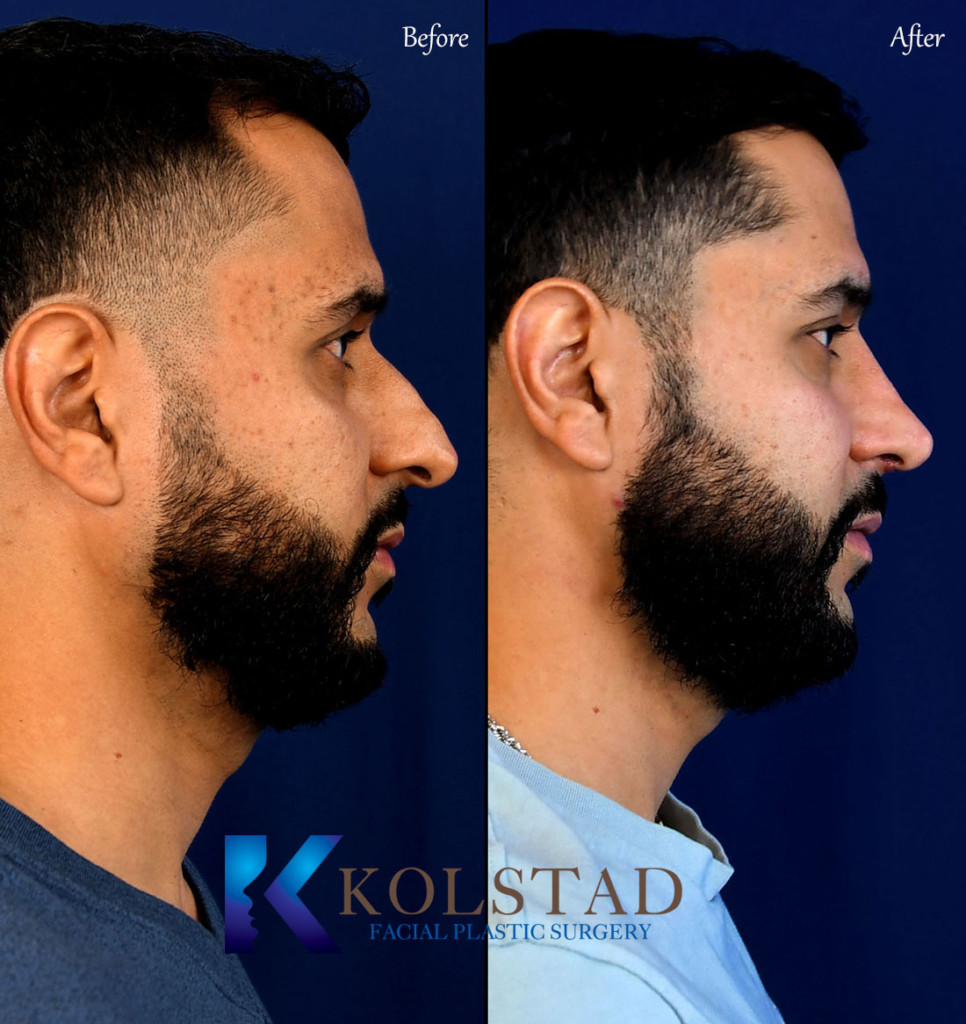 best nose job san diego Dr. Kolstad San Diego Facial Plastic Surgeon