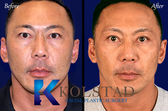 upper blepharoplasty before and after san diego