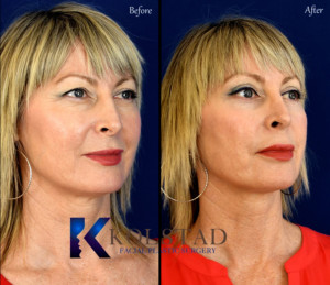 laser resurfacing