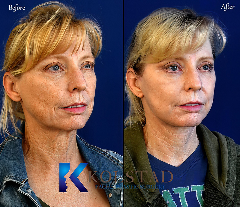 CO2 Fractional Laser Before & After - Glow Aesthetic Medicine