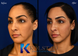 hair transplant for women