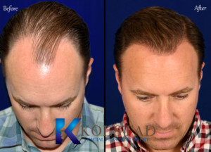 best hair transplant