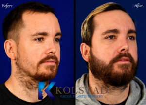 beard transplant