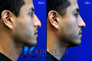 Nose Job for Hispanic Males