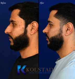 male rhinoplasty before and after