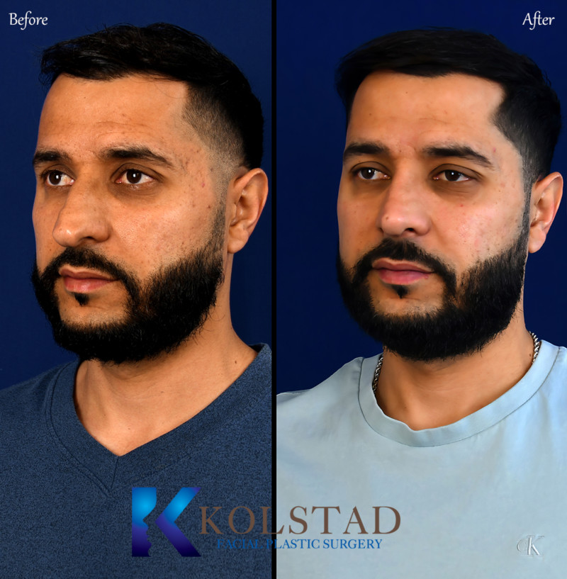 best nose job san diego Dr. Kolstad San Diego Facial Plastic Surgeon