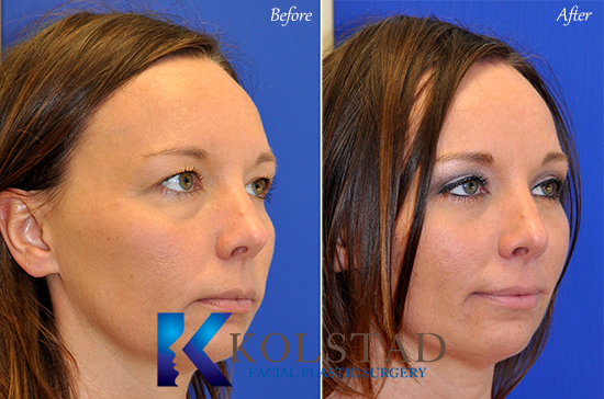 eyebrow lift procedure for women