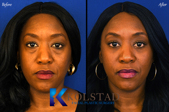recovery photos of lower blepharoplasty for women