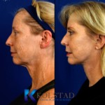 face lift before and after san diego