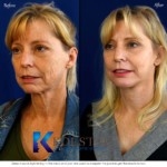 Facelift San Diego Before & After