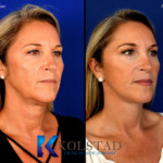 la jolla neck tightening before and after