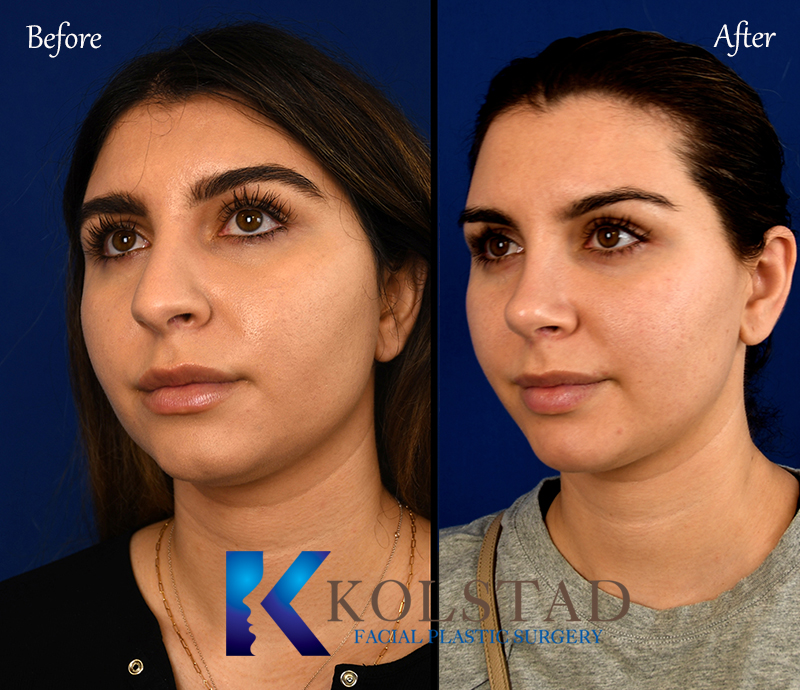 bad rhinoplasty before and after