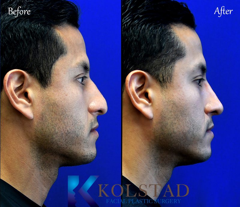 mens nose job results