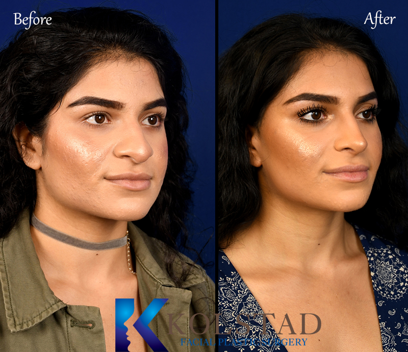 best middle eastern rhinoplasty