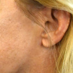 facelift scar in front of the ear