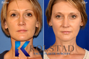 hooded upper eyelid surgery kolstad facial plastic surgery