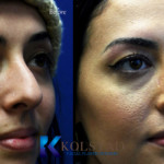 Before and after middle eastern rhinoplasty