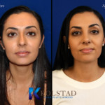 California rhinoplasty before and after