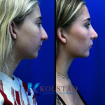Nose reshaping procedure