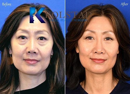 lower eyebag removal for asians