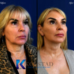 Lower facelift to remove jowels
