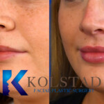 Lip Fillers Before and After Treatment