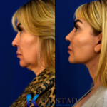 Side profile before and after mini facelift