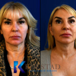 San Diego facelift results
