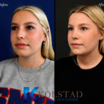 best nose job before and after california