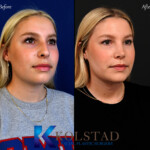 best nose job before and after san diego