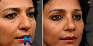 best piezo rhinoplasty