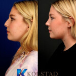 best rhinoplasty before and after