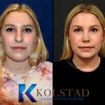 best rhinoplasty california