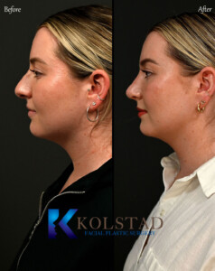 best ultrasonic rhinoplasty surgeon