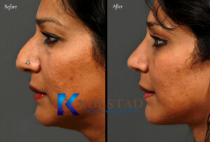 best ultrasonice rhinoplasty surgeon california