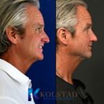 mens rhinoplasty california before and after