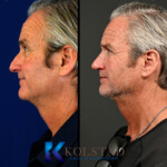 mens rhinoplasty california examples