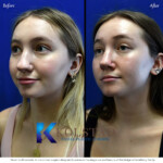 nasal tip rhinoplasty