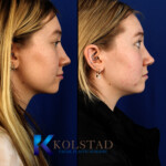 nasal tip rhinoplasty before and after