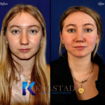 nasal tip rhinoplasty california